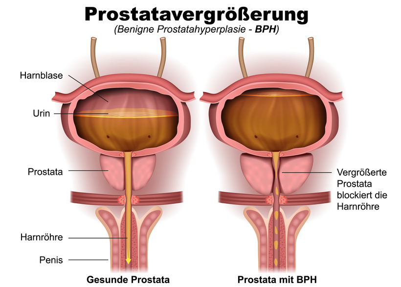 benigne Prostatahyperplasie (BPH)