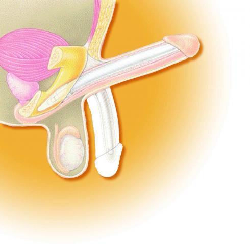 Biegsames Schwellkörperimplantat (Penisprothese)