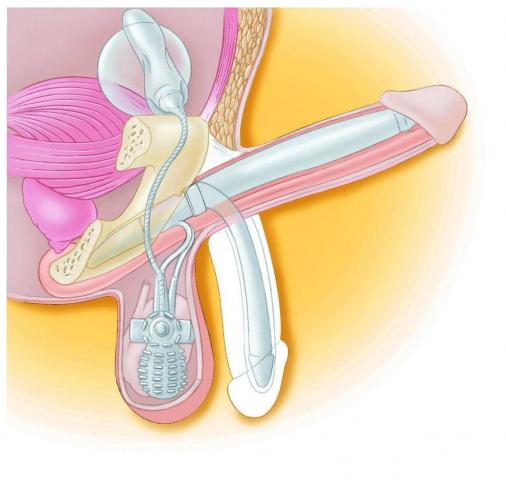 Hydraulisches Schwellkörperimplantat (Penisprothese)