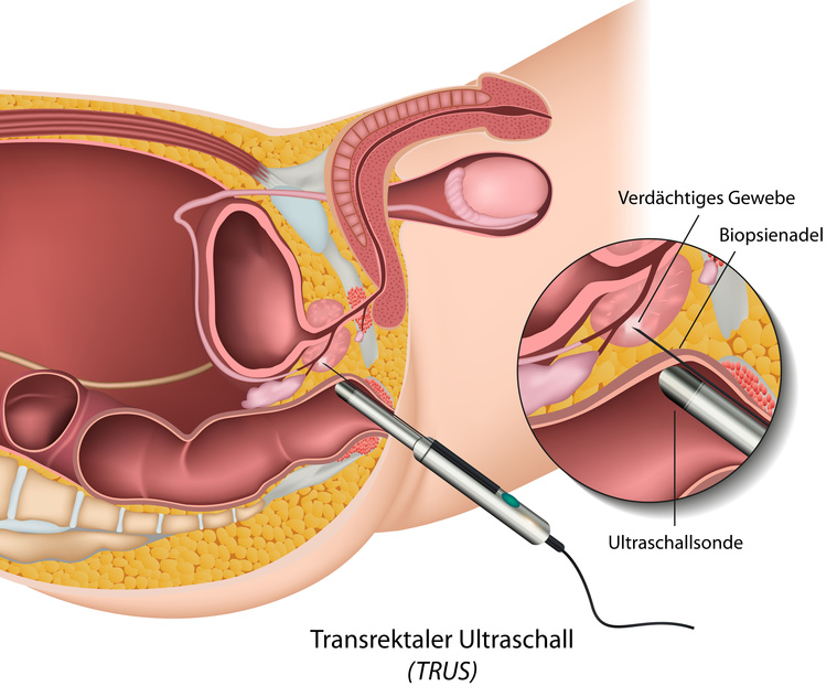 Schematische Darstellung der Prostatabiopsie