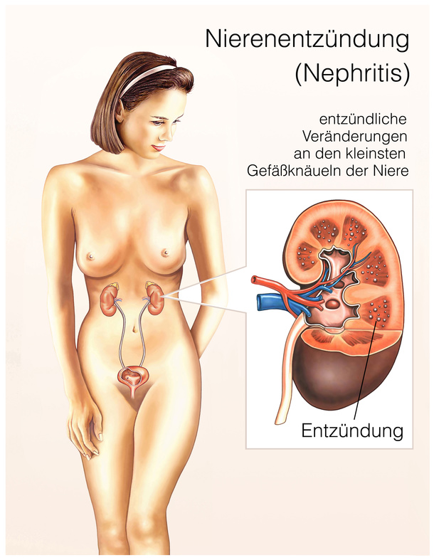 Nierenentzündung (Nephritis)