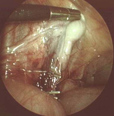 Zweizeitige laparoskopische Fowler-Stephens-Operation bei Bauchhoden, 1. OP