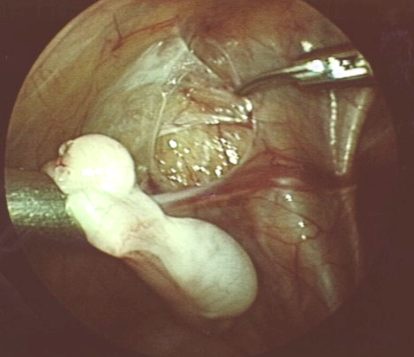 Zweizeitige laparoskopische Fowler-Stephens-Operation bei Bauchhoden, 2. OP