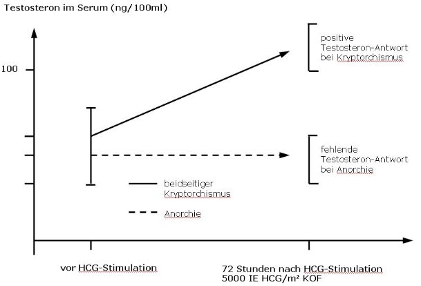 HCG-Test beim bilateralen Kryptorchismus: 72 Stdunden nach HCG-Gabe Testosteron-Anstieg nur bei Bauchhoden