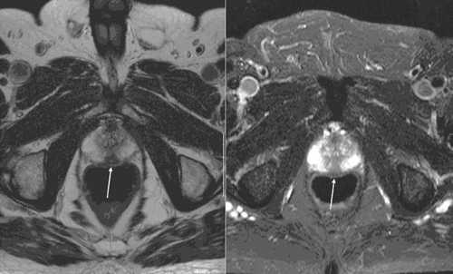 Kernspintomographisches Bild eines Prostatakarzinoms (Prof. Lenz, Radiologische Klinik KSK Reutlingen)